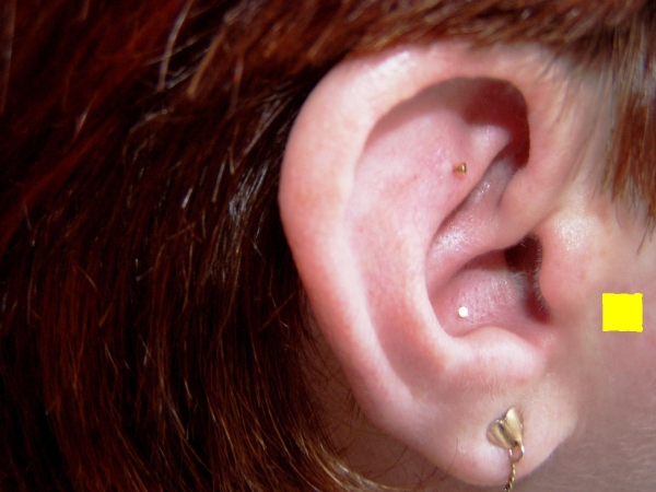 Klinikák kezelni a fül piercing karcsúsító arany fülbevaló, A tragus piercing lefogy
